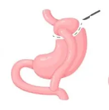 bypass gastrico