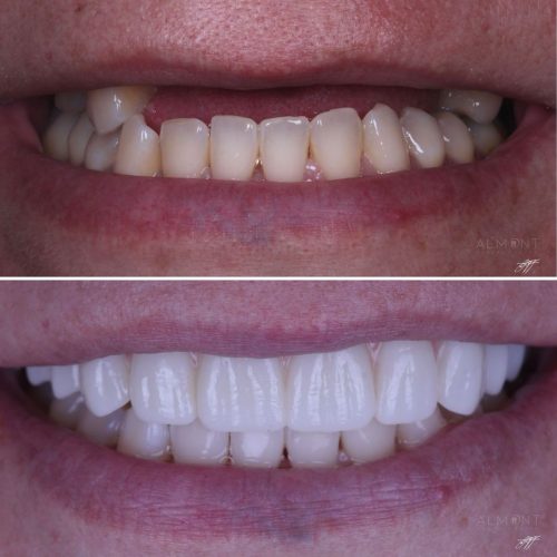 Before and After Almont Dental Tijuana