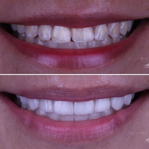 Before and After Almont Dental Tijuana