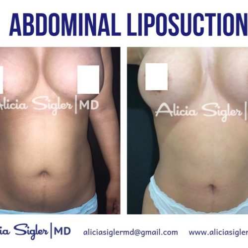 Dr Alicia Sigler Abdominal Liposuction