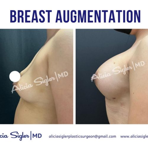 Dr Alicia Sigler Brest Augmentatio