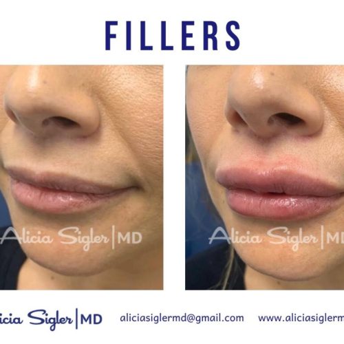 Dr Alicia Sigler Fillers