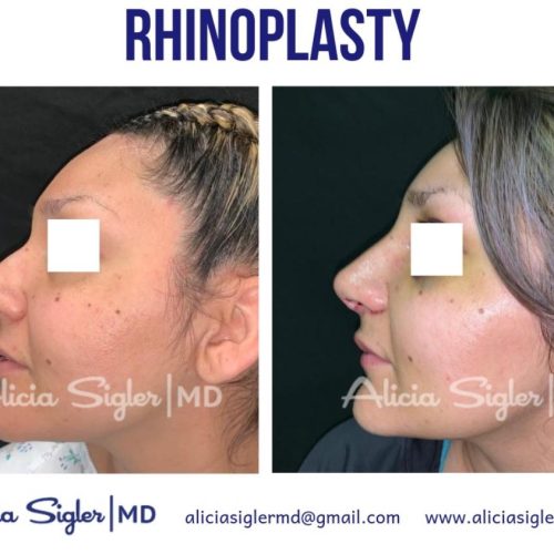 Dr Alicia Sigler Rhinoplasty 2